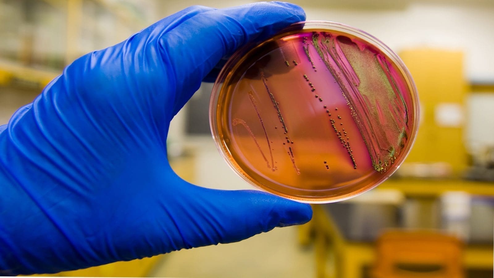 Santé publique France looks into increased cases of hemolytic uremic syndrome, E.coli